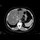 Liver steatosis: CT - Computed tomography